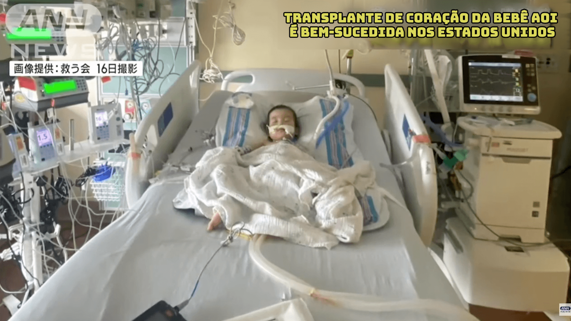 Transplante de coração da bebê Aoi é bem-sucedido nos Estados Unidos